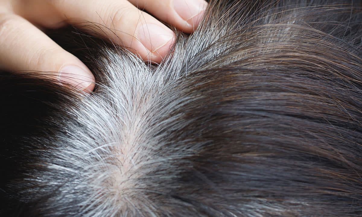 Tóc bạc sớm có sao không? Bác sĩ bệnh viện Bạch Mai giải đáp
